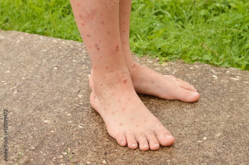 Close-up of children's legs strewn with ulcers and sores, combed from insect bites. photo