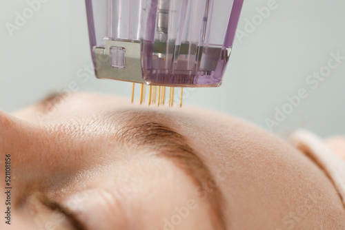 Microneedle mesotherapy. Woman receiving micro needling rejuvenation treatment in a cosmetology clinic. photo