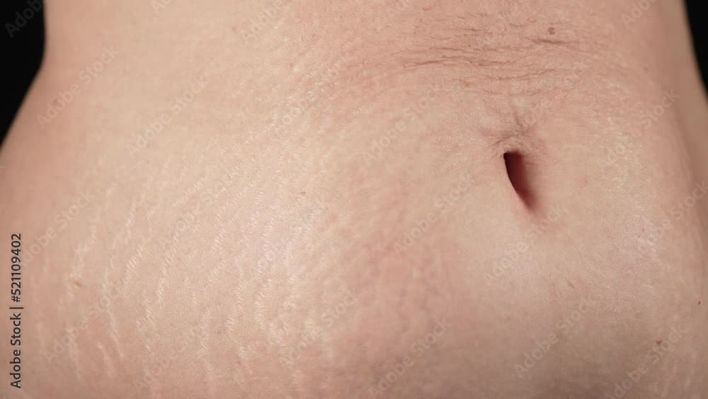 Woman showing stretch marks on abdomen after pregnancy. Natural body texture. Mothers belly with heavy wrinkles,loose skin after birth child.Health care,rehabilitation,body positive,accepting yourself Woman showing stretch marks on abdomen after pregnancy. Natural body texture. Mothers belly with heavy wrinkles,loose skin after birth child.Health care,rehabilitation,body positive,accepting yourself