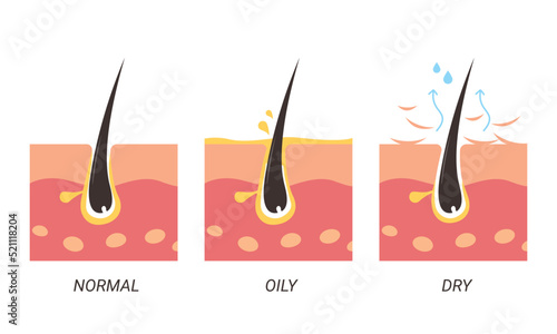 Normal, oily, and dry pores illustration