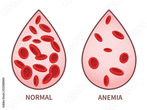 Hemoglobin. Anemia symptoms, blood disease. Health care concept.