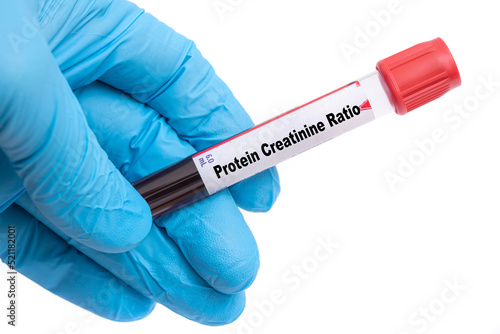 Protein Creatinine Ratio Medical check up test tube with biological sample photo