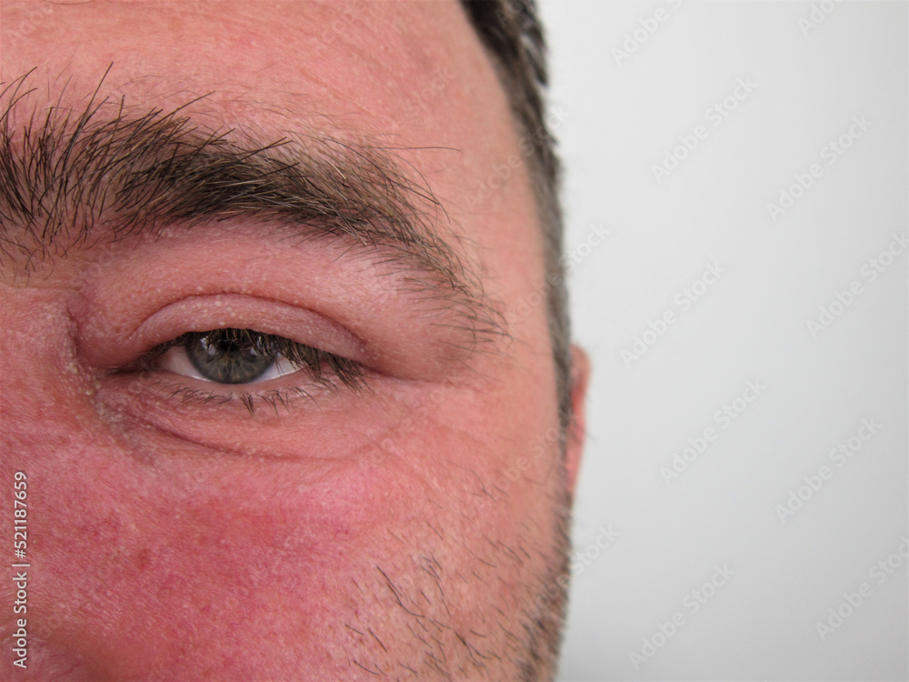   Swelling around the eyes in Man Affected by Conjunctivitis or Allergy. Irritated, Infected Eye or Insect Bite              