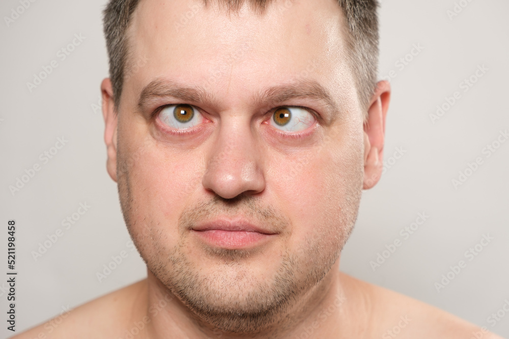 Obraz premium A man with strabismus squints his eyes on a white background.