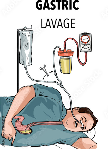 Gastric lavage with a gastric tube  photo