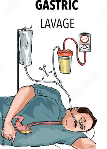 Gastric lavage with a gastric tube 