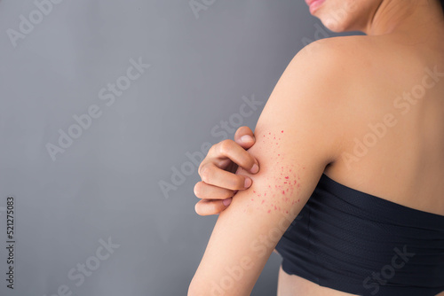 Wallpaper Mural Young woman scratching her arm due to skin itching. atopic dermatitis Dermatitis, hives, psoriasis Rash from insect bites, blister bites, mosquito bites, fungal skin infections. copy space Torontodigital.ca