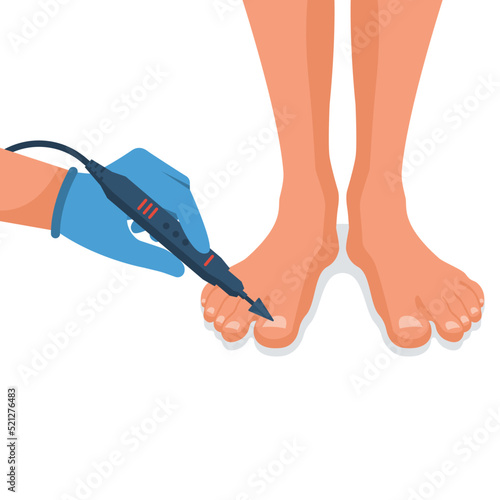 Podiatry concept. Feet treatment. Hardware medical pedicure. Nail cleaning apparatus. Patient on pedicure with pediatrician chiropodist. Clinic podology. Cosmetics of nails of legs. Vector design flat