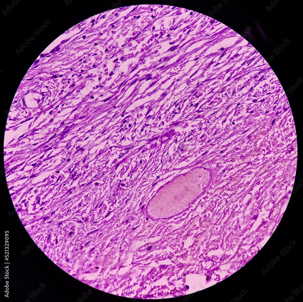 Dermoid Cyst Mature Cystic Teratoma Show Skin Adnexal Structure