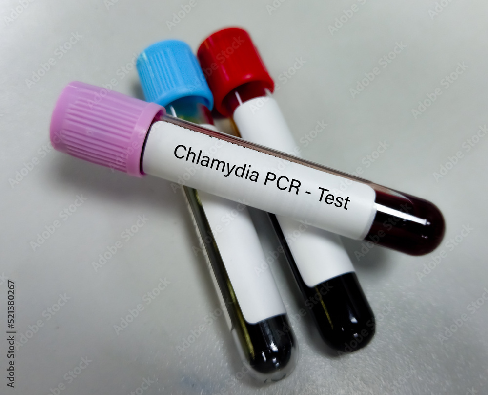 Naklejka premium Blood sample for Chlamydia PCR test or polymerase chain reaction for Chlamydia to detect STD.