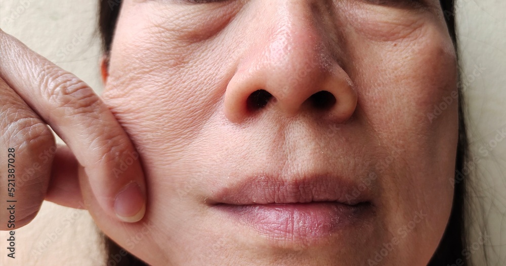 portrait showing the fingers squeezing the Flabby wrinkled beside the cheek, dullness and dark spots beside the mouth, problem blemishes and freckles on the face of the woman, concept health care.