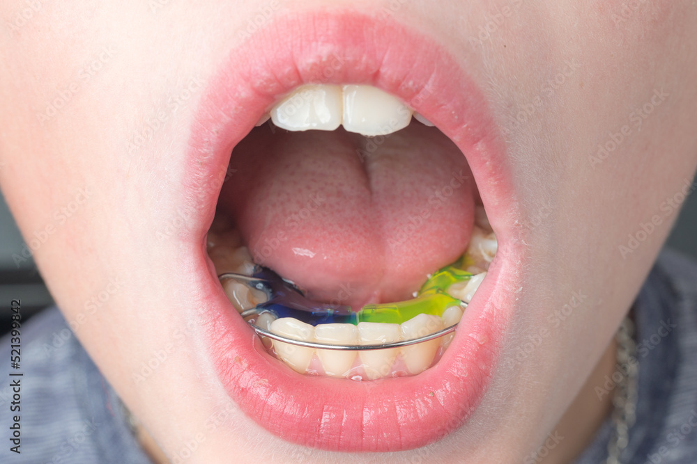 Obraz premium The boy wears a dental plate on his lower jaw.