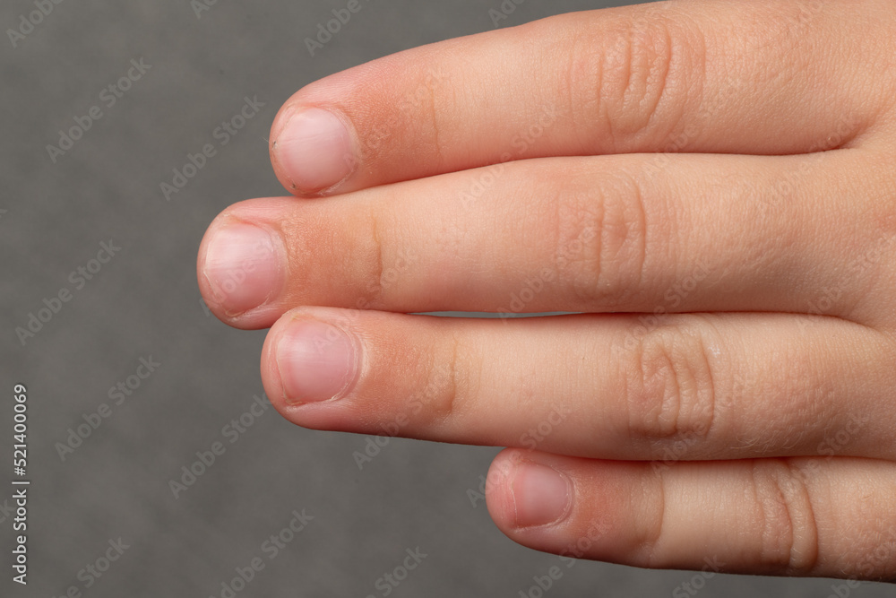 Child's dirty and sloppily cut nails, fingers and toenails close-up. Child's dirty and sloppily cut nails, fingers and toenails close-up.