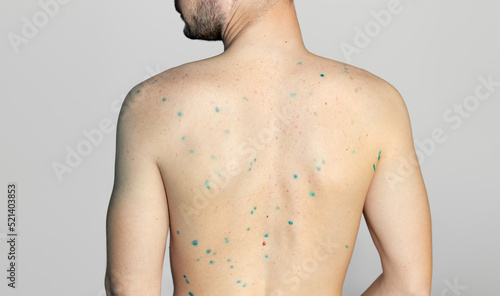 Obraz na plátně Body of adult  man have spotted, red pimple and bubble rash from chickenpox or varicella zoster virus
