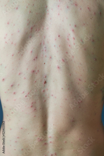 Fotografie Body of adult  man have spotted, red pimple and bubble rash from chickenpox or varicella zoster virus
