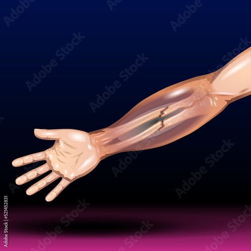 Canvas-taulu Hand Bone Fracture - Distal radius fracture and broken arm bone types anatomy -