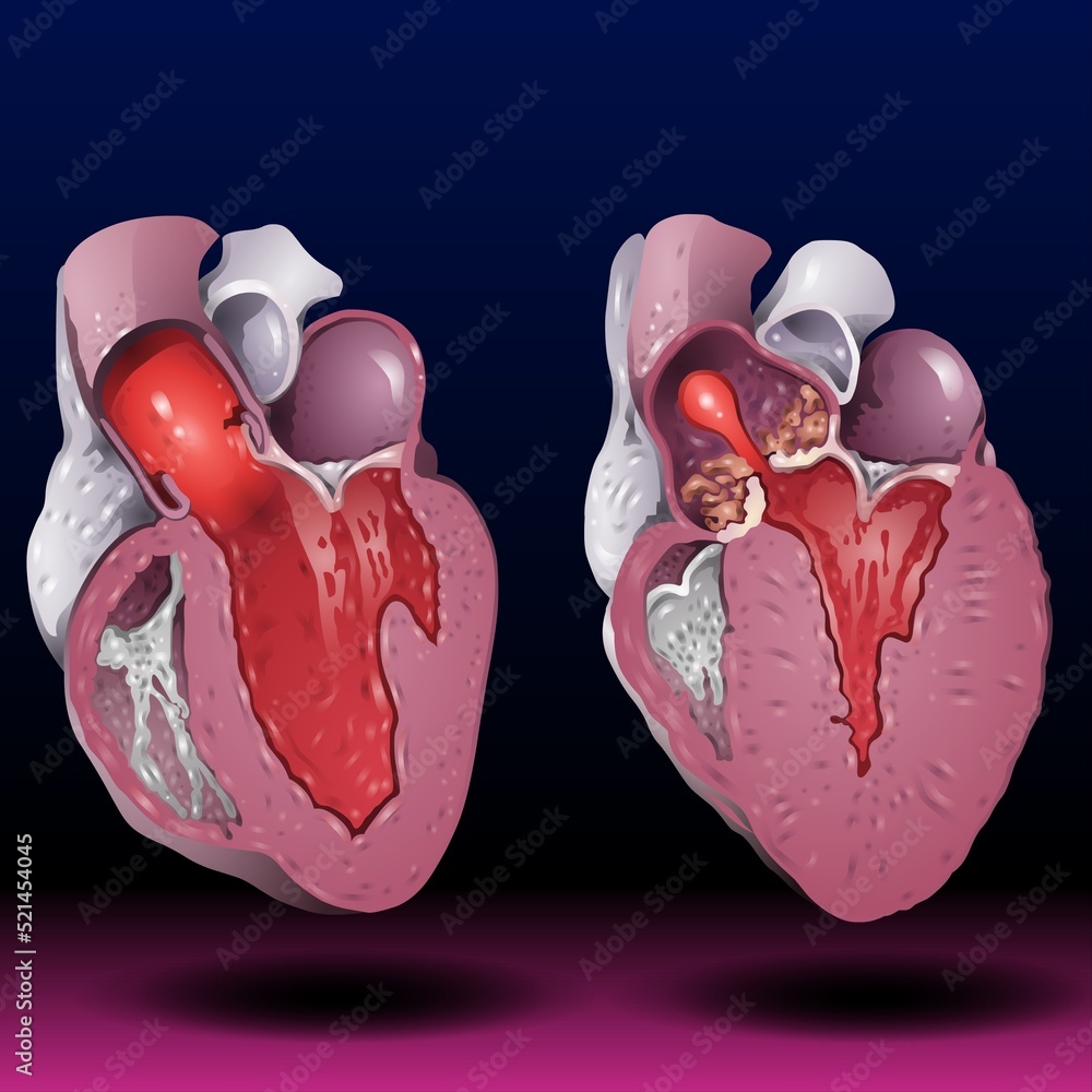 Human heart. Anatomical muscular human pumps blood organ, cutaway