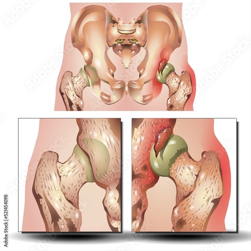 vector illustration of a pelvis hip fracture. hip dislocation on white background