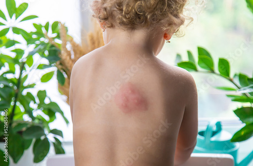 Mosquito bites on a child back. Selective focus. © yanadjan