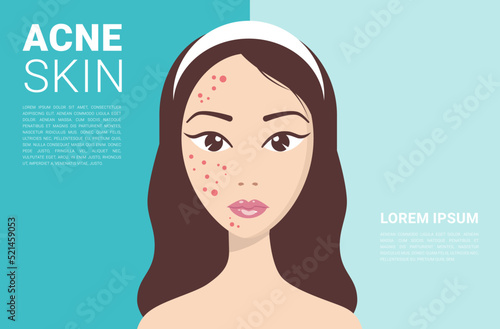 problematic skin concept. Sad girl with pimples on her face on a blue background vector illustration
