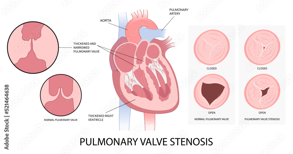 Heart Murmur Mitral Valve Heart Murmur Mitral Valve