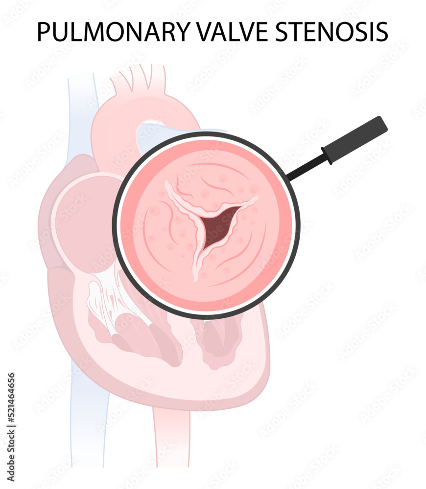 atrium balloon surgery cardiac disease heart murmur Cath lab for TAVI