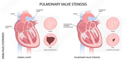 cardiac heart murmur disease Cath lab for TAVI or TAVR stroke aortic repair right left atrial fever atresia mitral valve floppy with Barlow birth syndrome rhythm atrium balloon surgery