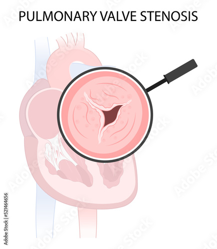 atrium balloon surgery cardiac disease heart murmur Cath lab for TAVI or TAVR stroke aortic repair right left atrial fever atresia mitral valve floppy with Barlow birth syndrome rhythm