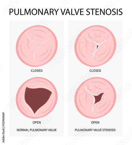 heart murmur disease cardiac surgery Cath lab for TAVI or TAVR stroke aortic repair right left atrial fever atresia mitral valve floppy with Barlow birth syndrome rhythm atrium balloon