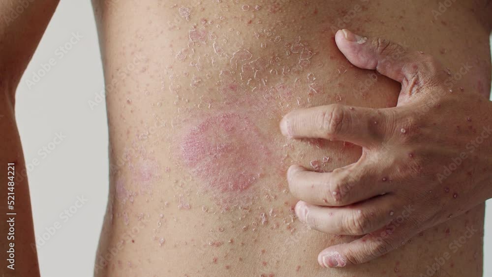 Psoriasis is the abdomen on white background. 4K Slow Motion VDO Psoriasis is the abdomen on white background. 4K Slow Motion VDO