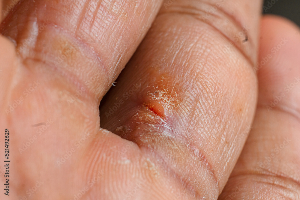 Fototapeta premium Macro photo of hands with fungus crusted fingers. skincare concept.