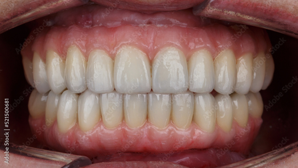 excellent dental prostheses with a beautiful artificial gum in the patient's mouth - obrazy, fototapety, plakaty 