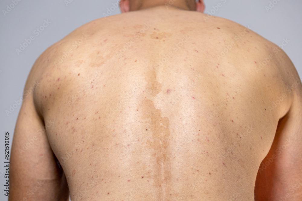 tinea versicolor on the back. pityriasis versicolor problem with skin