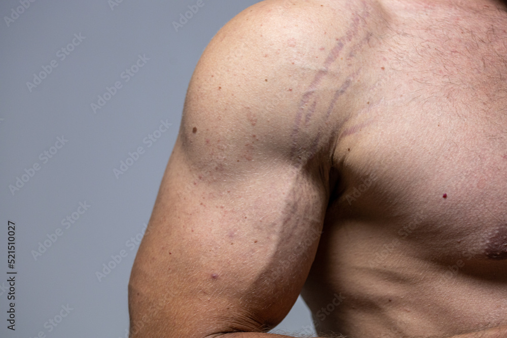 close up striae distensae. stretch marks on the arm. male torso
 - obrazy, fototapety, plakaty 