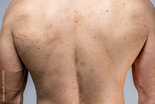 tinea versicolor on the back. pityriasis versicolor problem with skin.  acne skin back. scoliosis photo