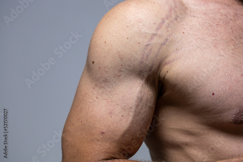 close up striae dispense. stretch marks on the arm. male torso photo