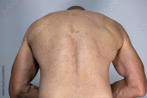 tinea versicolor on the back. pityriasis versicolor problem with skin.  acne skin back photo