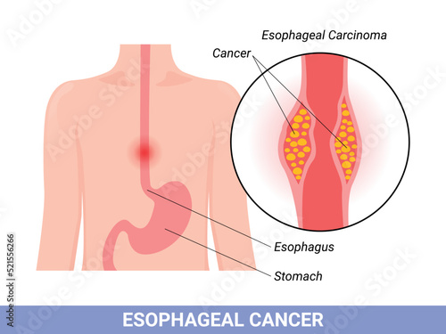 Medical illustration of the symptoms of esophageal carcinoma photo