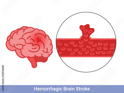 Hemorrhagic brain stroke concept. Apoplexy, cerebral hemorrhage, headache problem photo