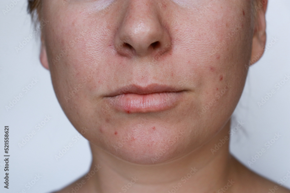 Obraz premium close up natural woman bad acne skin with scars