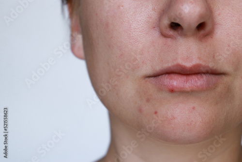 close up natural woman bad acne skin with scars