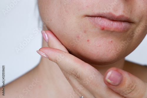 close up natural woman bad acne skin with scars