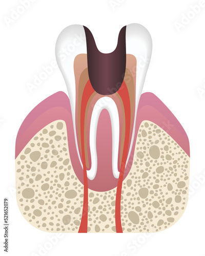 Stage of caries development. Tooth structure in flat style. Tooth decay with enamel. Dental disease realistic vector illustration