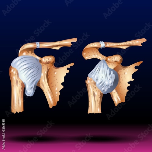 Shoulder Dislocation - Fla source file available - A dislocated shoulder is an injury in which the upper arm bone pops out of the cup-shaped socket that's part of the shoulder blade. photo
