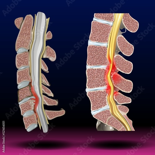 Spinal Stenosis - Fla source file available - Spinal stenosis can put pressure on the spinal cord and the nerves within the spine. It commonly occurs in the neck and lower back. photo