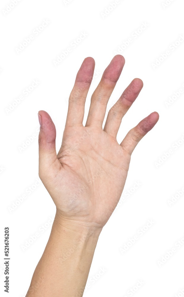Cyanotic hands or peripheral cyanosis or blue hands at Southeast Asian, Chinese young man Cyanotic hands or peripheral cyanosis or blue hands at Southeast Asian, Chinese young man