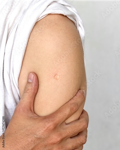 BCG or TB vaccine scar mark at the arm of Asian man. photo