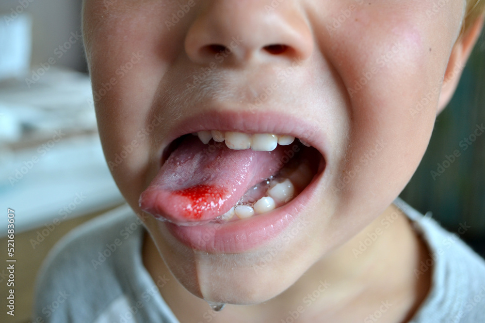 Child's bitten tongue. Close-up of lips, tongue, protrusion of blood Child's bitten tongue. Close-up of lips, tongue, protrusion of blood