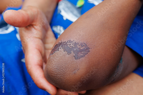 Photos Large, healing scab on the arm of a young boy of african ethnicity