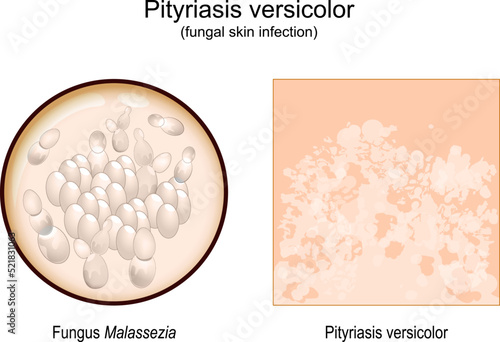 pityriasis versicolor. skin surface. Malassezia fungi photo